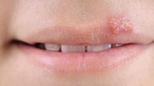 Nhiễm Herpes Simplex (HSV) là gì?
