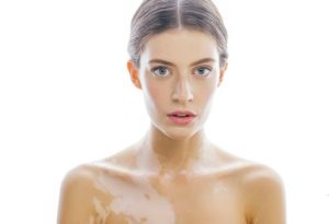 Điều trị bệnh bạch biến