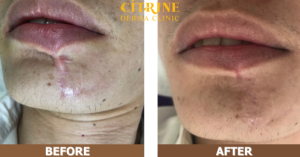 Hiệu quả điều trị sẹo