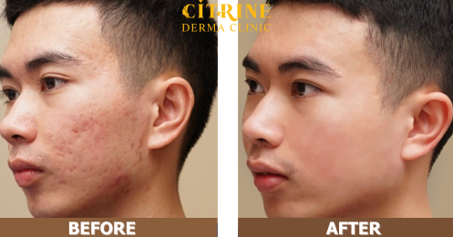 Hiệu quả điều trị mụn dậy thì