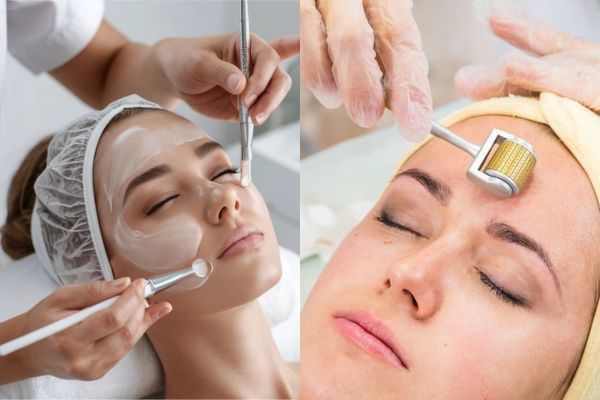 Lăn kim kết hợp peel da giúp tái tạo collagen và làm mờ nếp nhăn hiệu quả