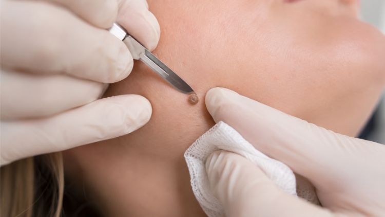 Cạo nốt ruồi gồ phù hợp với một số tổn thương lành tính