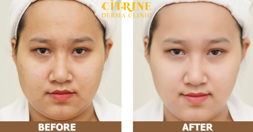 Hiệu quả điều trị nám