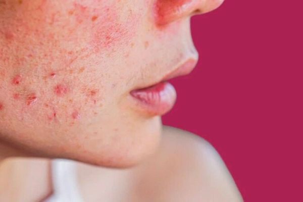 Da nhạy cảm nên tránh thành phần mỹ phẩm nào