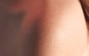 Điều trị Dày Sừng Nang Lông