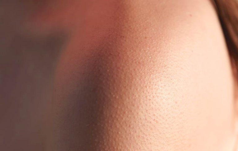 Điều trị Dày Sừng Nang Lông