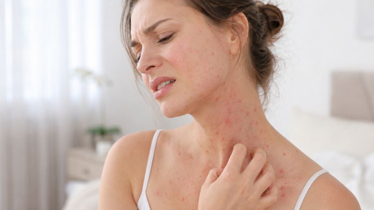 Gãi, chọc vỡ nốt phỏng và tự dùng thuốc có thể làm da tổn thương nặng hơn