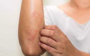 Nhiễm kí sinh trùng – Triệu chứng & cách phòng tránh