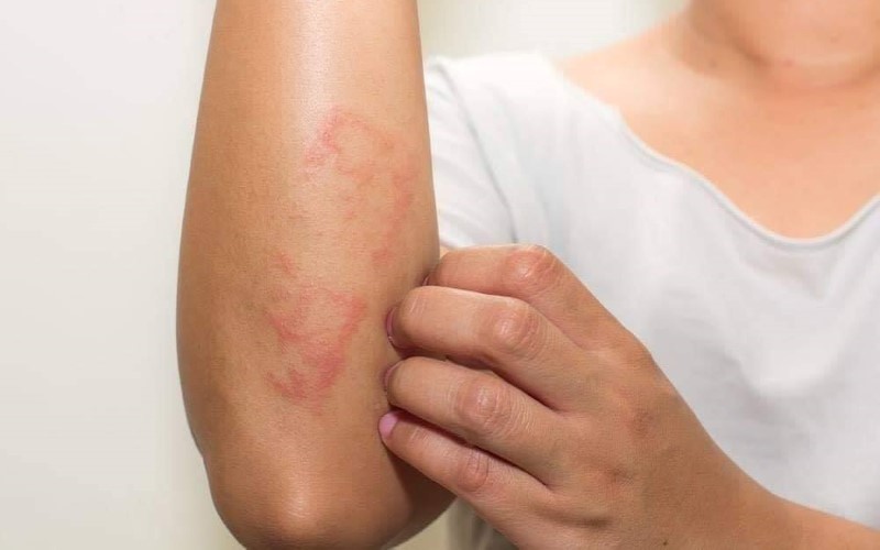 Nhiễm kí sinh trùng – Triệu chứng & cách phòng tránh