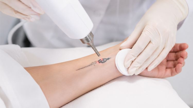 Laser tác động chọn lọc để phá nhỏ sắc tố mực xăm