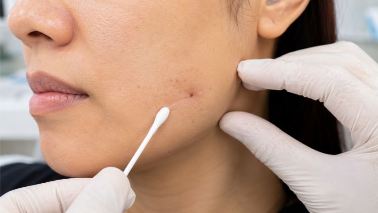 Nốt ruồi có thể để lại sẹo hoặc xuất hiện trở lại