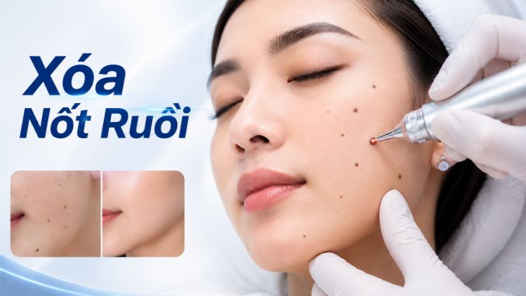 xoá nốt ruồi