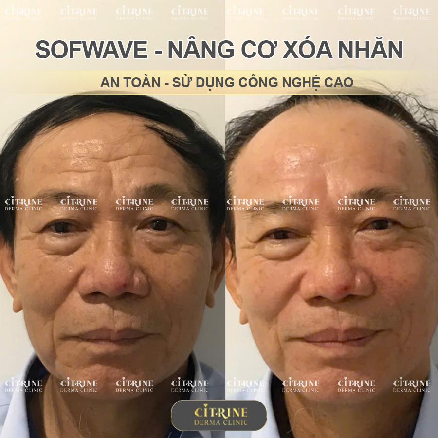 Nâng cơ trẻ hóa Sofwave