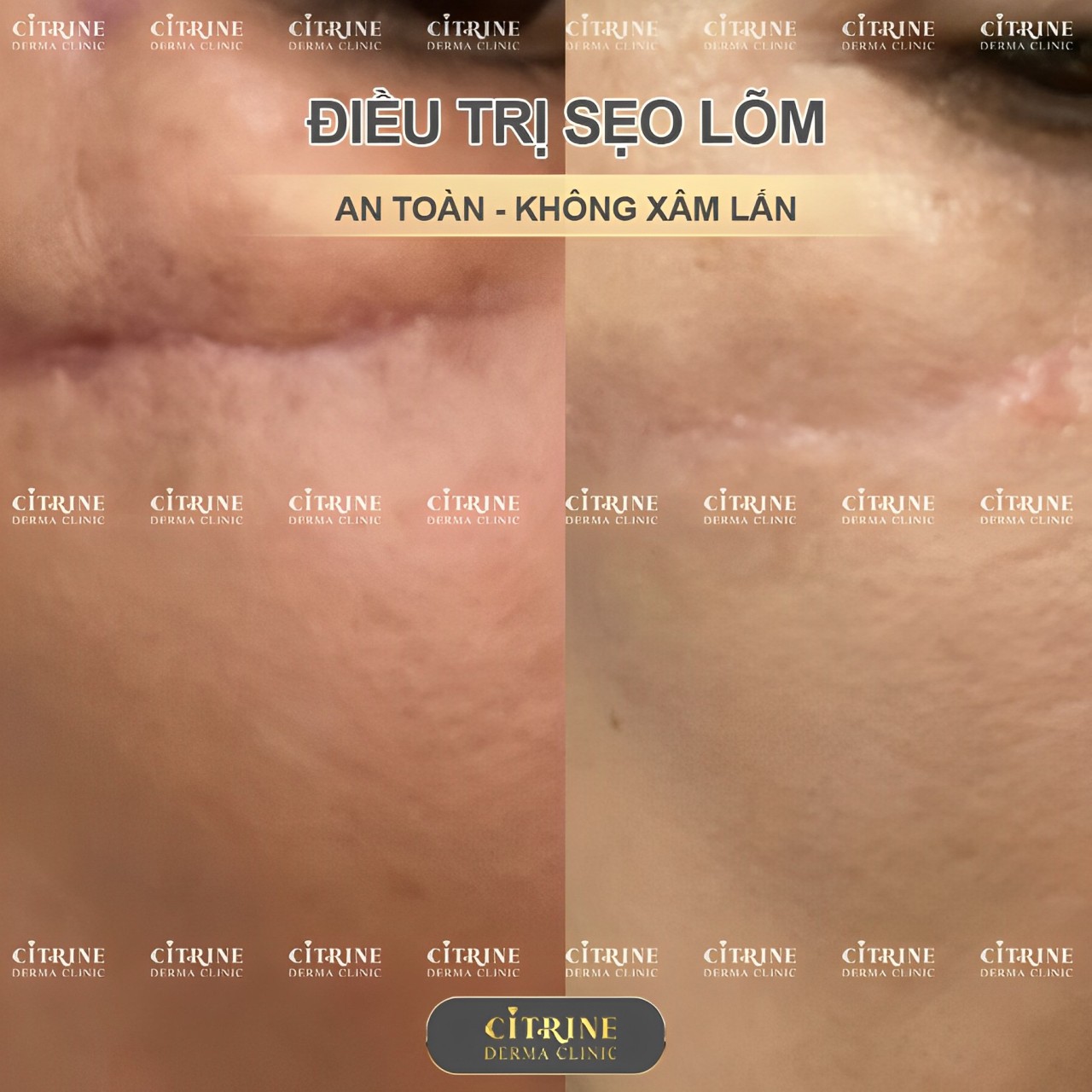 Hình ảnh sẹo lõm sau phẫu thuật