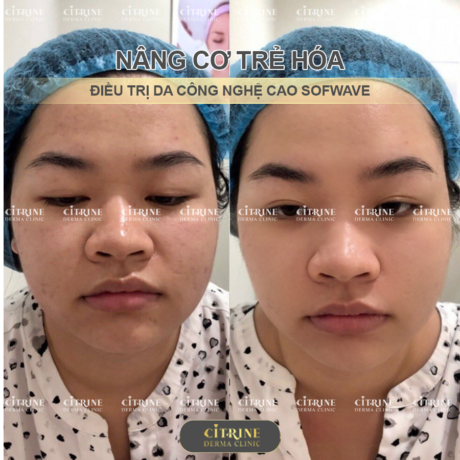 Nâng cơ trẻ hóa Sofwave