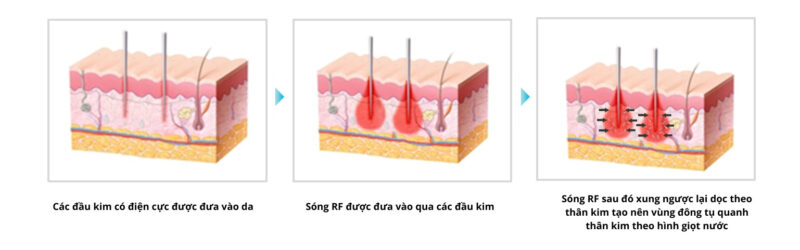 Nâng cơ bằng sóng RF có tốt không?