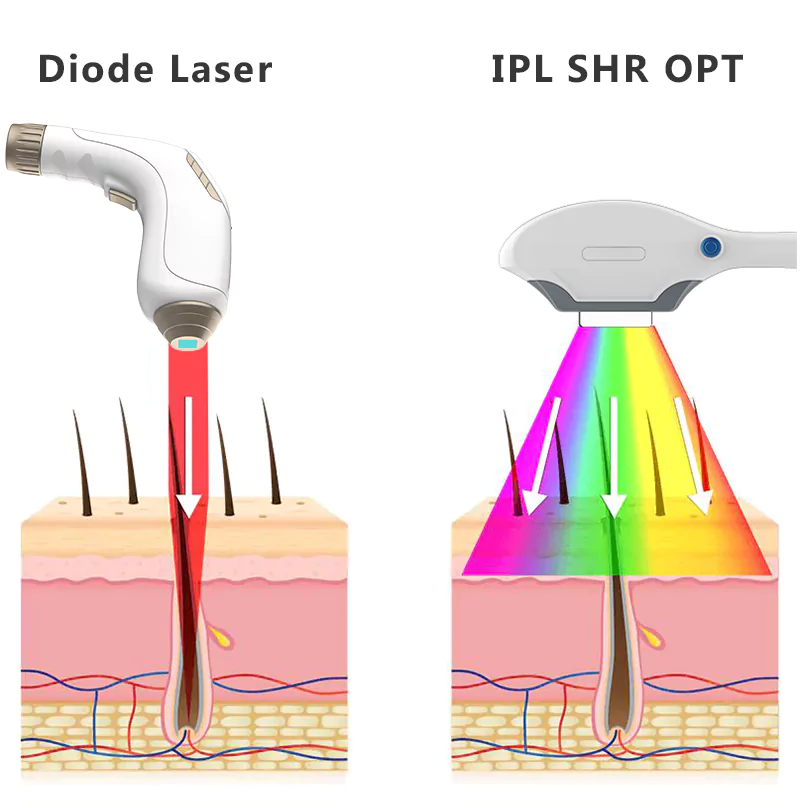 Triệt lông IPL và Diode Laser khác gì nhau?