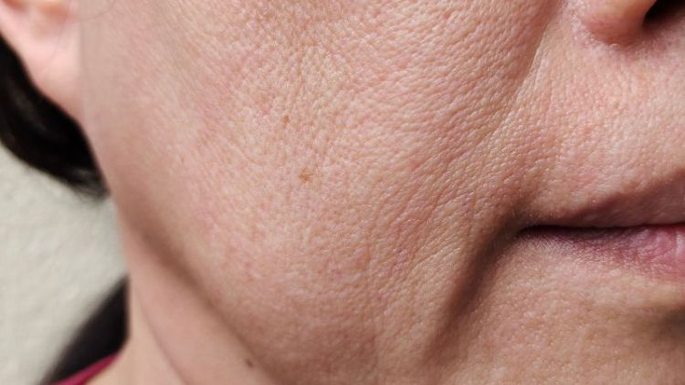 Mức độ nặng da dư nhiều, mô mặt sa trễ rõ