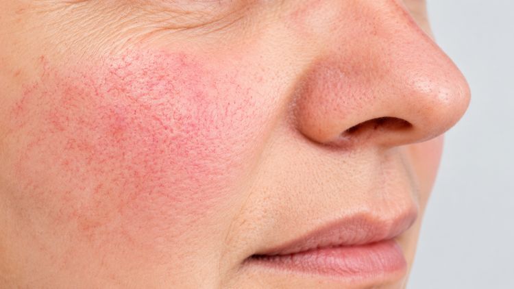 Đỏ da, giãn mao mạch và sẩn viêm ở mụn trứng cá đỏ 