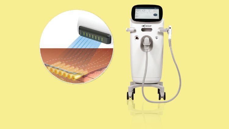 Công nghệ Superb trong Sofwave là gì