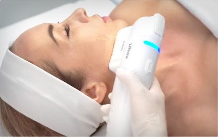 Quy trình điều trị bằng máy HIFU gồm những bước nào?