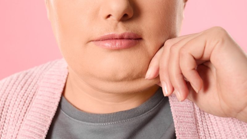 Liệu trình mỡ nọng cằm cần được cá nhân hóa theo từng tình trạng vùng cằm - cổ
