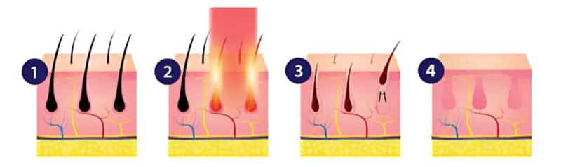 Cơ chế hoạt động của Laser Fotona