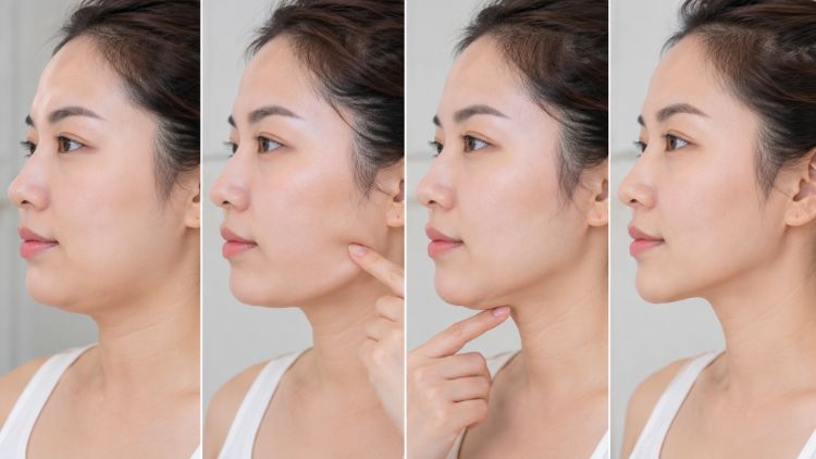 Hàm kém gọn do đâu? Khi nào HIFU có thể phù hợp?