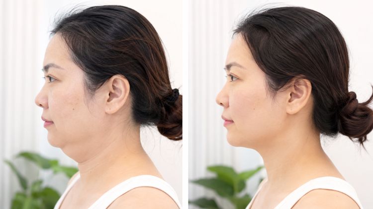Người có đường viền hàm kém rõ hoặc nọng cằm nhẹ kèm da dưới cằm lỏng