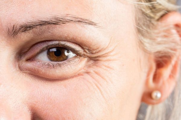 Botox xóa nhăn phù hợp người bận rộn, ngại phẫu thuật