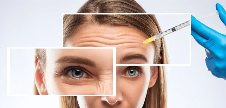 Botox làm mờ các nếp nhăn động một cách tự nhiên