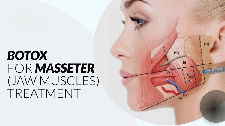 Botox Masseter – Thon gọn hàm, Tạo V-Line tự nhiên