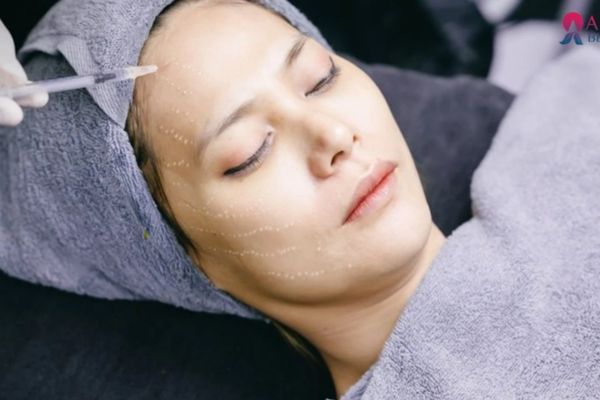 Botox xóa nhăn giúp gương mặt thanh thoát, trẻ trung và tự tin hơn