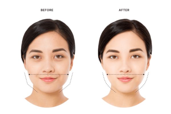 Botox gọn hàm phát huy hiệu quả sau 2–4 tuần, giúp khuôn mặt thon gọn tự nhiên