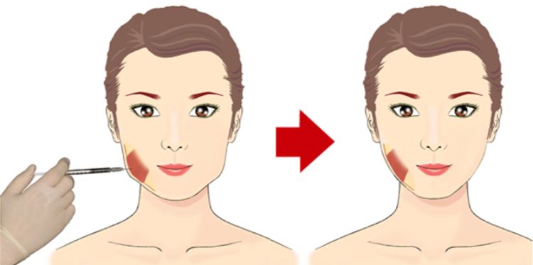 Mặt vuông do cơ cắn phát triển mạnh