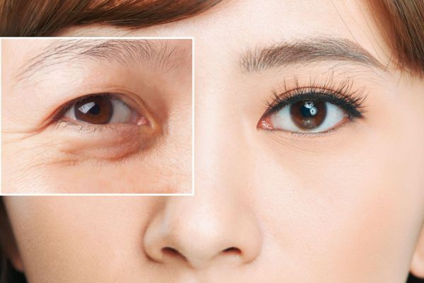 Sofwave phù hợp người lão hóa nhẹ đến trung bình và cần được thăm khám trước