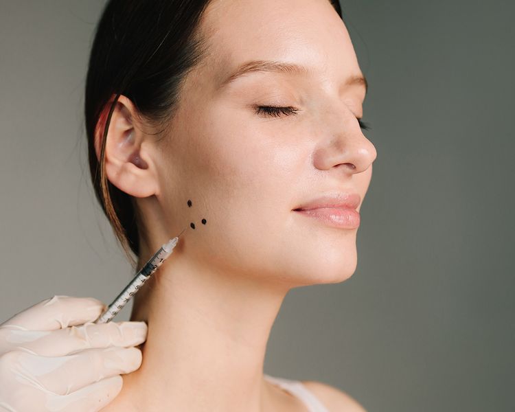 Thon gọn hàm không phẫu thuật bằng botox