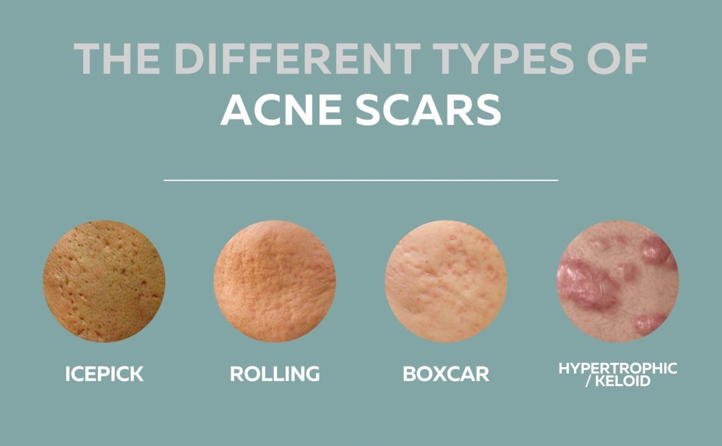Acne Scar Treatment With Laser And Subcision