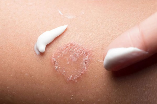 dieu tri bang thuoc khang nam