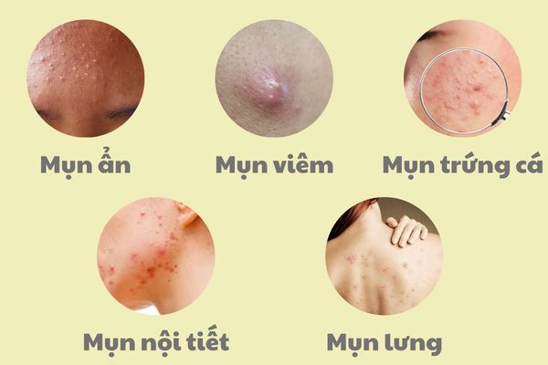 Mỗi loại mụn cần phác đồ điều trị riêng để đạt hiệu quả tối ưu