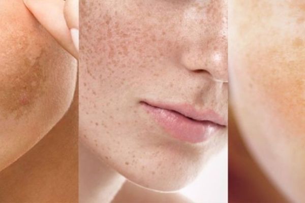 cac loai nam da thuong gap