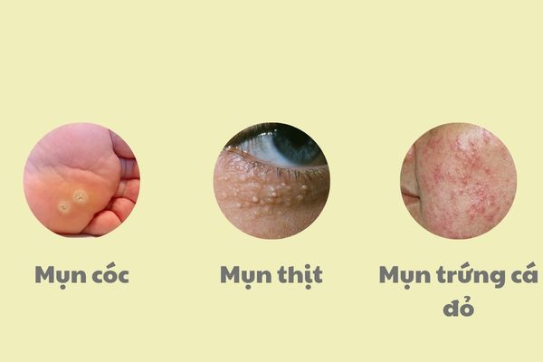 Một số tổn thương da dễ nhầm mụn, cần can thiệp da liễu chuyên sâu