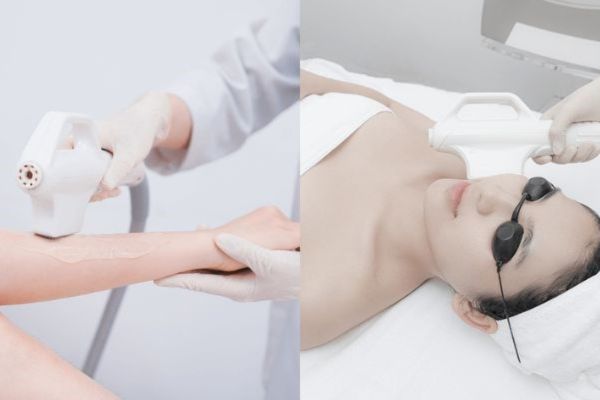 Triệt lông IPL tác động chọn lọc vào nang lông, an toàn và ít đau rát
