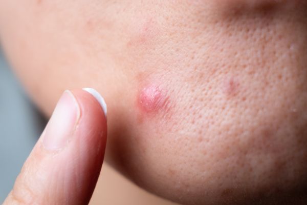 Hoạt chất phù hợp quyết định hiệu quả điều trị mụn