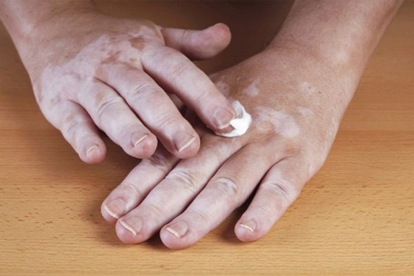 phuong phap dieu tri truyen thong