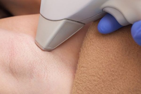 chi phi triet long bang laser