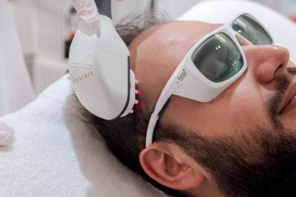Điều trị rụng tóc bằng laser HAIRestart công nghệ cao hiệu quả, an toàn và lâu dài