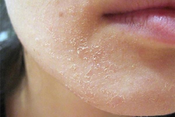 viem da tiet ba la gi