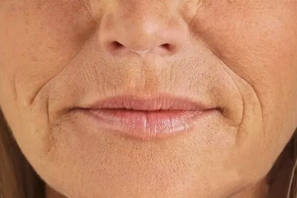 tiem filler ranh mui ma phu hop voi nguoi co ranh sau