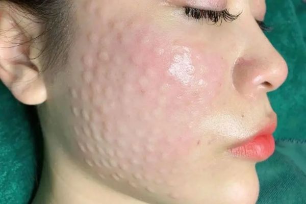 Sau tiêm, da có thể đỏ nhẹ, sần nhẹ nhưng là phản ứng bình thường